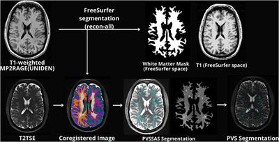 Semi-automated Segmentation and Quantification of Perivascular Spaces at 7 Tesla in COVID-19